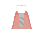 人工歯の装着